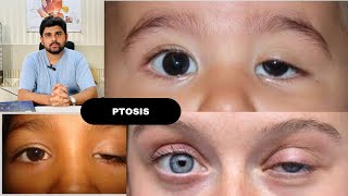 Ptosis and its classification drhashimjabbar education optometry eye ptosis [upl. by Washington]