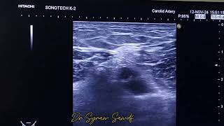 adductor canal block for post op analgesia at knee joint [upl. by Ignatzia]