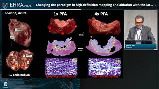 EHRA Congress 2024 Highdefinition mapping and ablation [upl. by Akiemahs]