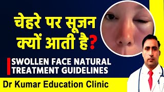 SWOLLEN FACE NATURAL TREATMENT GUIDELINESचेहरे पर सूजन क्यों आती है [upl. by Mueller]