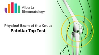 Rheumatology KNEE exam Patellar Tap Test [upl. by Gallager]