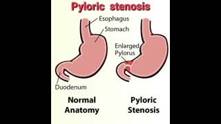 Pyloric stenosis Fluid calculation mrcpch Recall Communication [upl. by Pren]