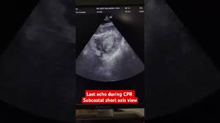 Last echo during CPR Subcostal short axis view [upl. by Hnilym]