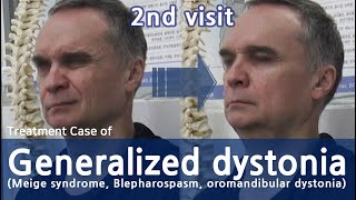 Generalized dystonia  Meige syndrome  Blepharospasm oromandibular dystonia  전신사경증 치료사례 [upl. by Ydisac]