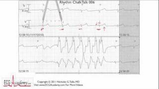 ECG Interpretation Tutorial  ChalkTalk 06  Basic Level [upl. by Kristofor]