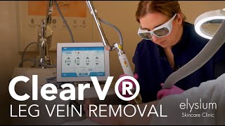 ClearV® Laser for Leg Vein Removal [upl. by Puritan539]