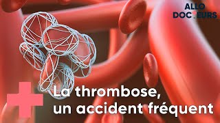 Thrombose  toutes vos questions  Allo Docteurs [upl. by Schober601]