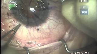 Wound Revision amp Compression Sutures for post PKP astigmatism [upl. by Graf808]