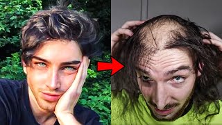 24 Year Old Model Had A Transplant But Stopped Taking Hair Loss Meds And This Is What Happened [upl. by Compton224]