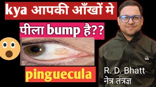 Pinguecula couses and Treatment pinguecula kya होता है और इसका ईलाज़ पीला bump [upl. by Nelleyram]