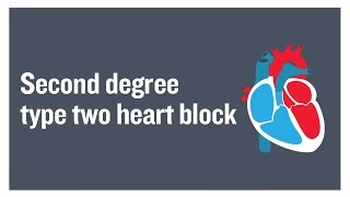 Second degree type two heart block [upl. by Clemens]