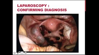 DAROGA Early Pregnancy Part 3 Ectopic Pregnancy and Gestational Trophoblastic Disease Dx and Mx [upl. by Keven]