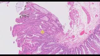 Sessile serrated adenoma with dysplasia [upl. by Elocon]