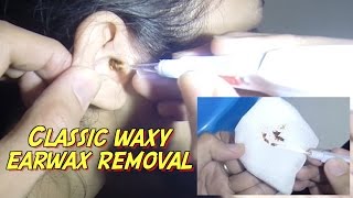 Classic Waxy Earwax Removal [upl. by Ingles]