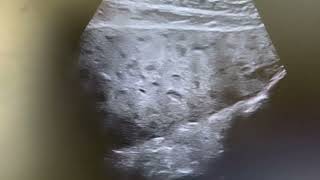 Ultrasound of multiple hypoechoic thickened intrahepatic biliary radicles due to biliary obstruction [upl. by Eninahs623]