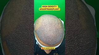 Hair Loss Treatment hair hairloss hairlosstreatment ytshorts alopecia hairtransplant hairfall [upl. by Anoniw]