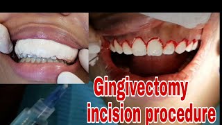 Gingivectomy incision procedure  gum cutting [upl. by Gustavo70]