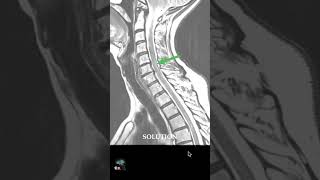 MRI  CERVICAL SPINE ARTEFACT [upl. by Neitsabes596]