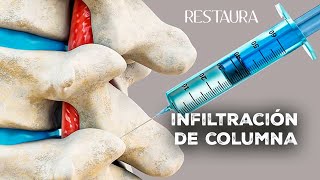 Infiltración de columna ¿Qué es ¿Qué se inyecta ¿Cuánto dura el efecto [upl. by Ahsocin]