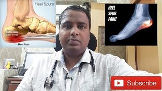 HEEL PAINCALCANEAL SPUR TREATMENTएड़ी के दर्द का इलाज [upl. by Aoniak]