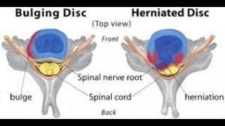 Disc Herniation vs Disc Bulge [upl. by Eintihw]