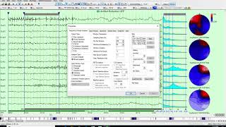 EEG FFT Frequency Maps in Persyst 14 [upl. by Strep]