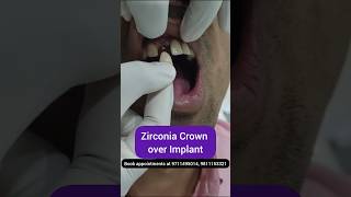 Zirconia Crowns over Implant Dr Srishti Bhatia smilemakeover [upl. by Victorie]