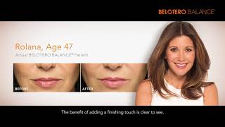 BELOTERO  Facial Filler [upl. by Carroll]