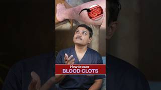 How to Treat Blood Clots Insights from vascularsurgeon shortvideo [upl. by Kiernan]