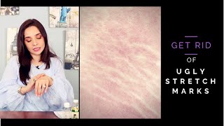 Remove Stretch Marks at Home in a Week  Remedies to Remove Stretch Marks  Hacks  Juggun Kazim [upl. by Eisiam]