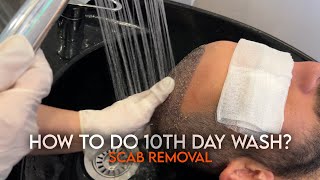 How to do 10th day Scab Removal Wash After Hair Transplantation I I Murat Makascı Clinic [upl. by Alyakim]