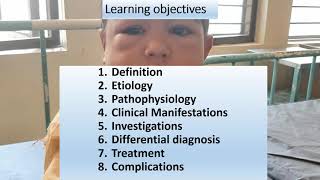 Nephrotic Syndrome  Pediatrics [upl. by Farrica]