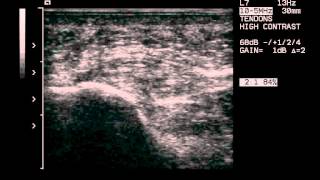 plantar fascia infiltrationwmv [upl. by Azilef]