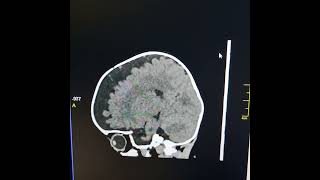 Agenesis of corpus callosum  External hydrocephalus [upl. by Ydnor]