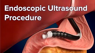 Endoscopic Ultrasound EUS Procedure  Cincinnati Childrens [upl. by Spevek]