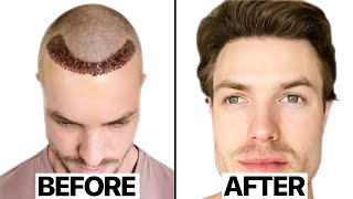 My Hair Transplant Results 6 Months  Surgeon Reacts [upl. by Annovad]