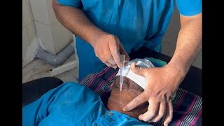 Needle cricothyroidotomy  DrSParthasarathy MD DNB PhD [upl. by Ynnavoj]