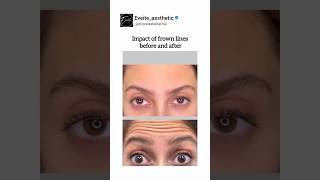 Whats the impact of frown linesHow its look before and aftercosmeticsurgery beauty skincare [upl. by Enrobyalc]