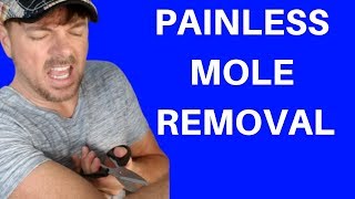 BEST WAY TO REMOVE MOLES  SKIN TAGS TOO  Chris Gibson [upl. by Adnoek]