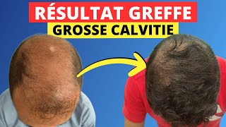 Greffe de cheveux et Calvitie Enorme  Ça vaut le coup La réponse en image 📹 [upl. by Sung]