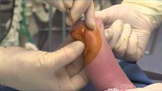 Foot Surgery The Ponseti Method for the Treatment of Clubfoot in Distal Arthrogryposis [upl. by Airetnahs]