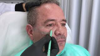 Acido Hialuronico Facial Region Periorbitaria Malar y Tercio Medio por Dr Martin Gaston Alvarez [upl. by Oeht]