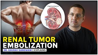 Kidney tumor treatment without surgery  Renal angiomyolipoma  Dr Gaurav Gangwani [upl. by Coray]