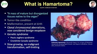 Patho Minutes What is Hamartoma [upl. by Otrevire]