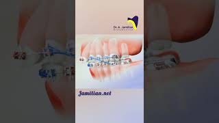 Upper Jaw Retraction Using First Molar Extraction bracs dentist orthodontics smile extraction [upl. by Herwick]