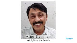 Mr Santosh Belavi appreciating Dr Karves Dentech for his Smile Correction Treatment [upl. by Odlavu773]