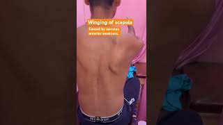 Winging of scapula scapula serratusanterior winging drshubh [upl. by Sewellyn]