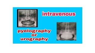 Intravenous Pyelography  Urography IVP  IVU [upl. by Semreh647]