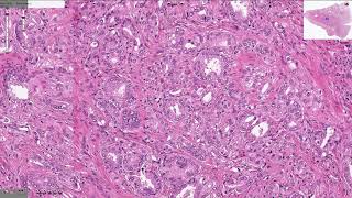 Prostatic Adenocarcinoma  Histopathology [upl. by Sorac]