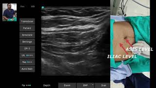 ULTRASOUND GUIDED ILIOINGUINAL amp ILIOHYPOGASTRIC NERVES SONOANATOMY [upl. by Ellehcil]